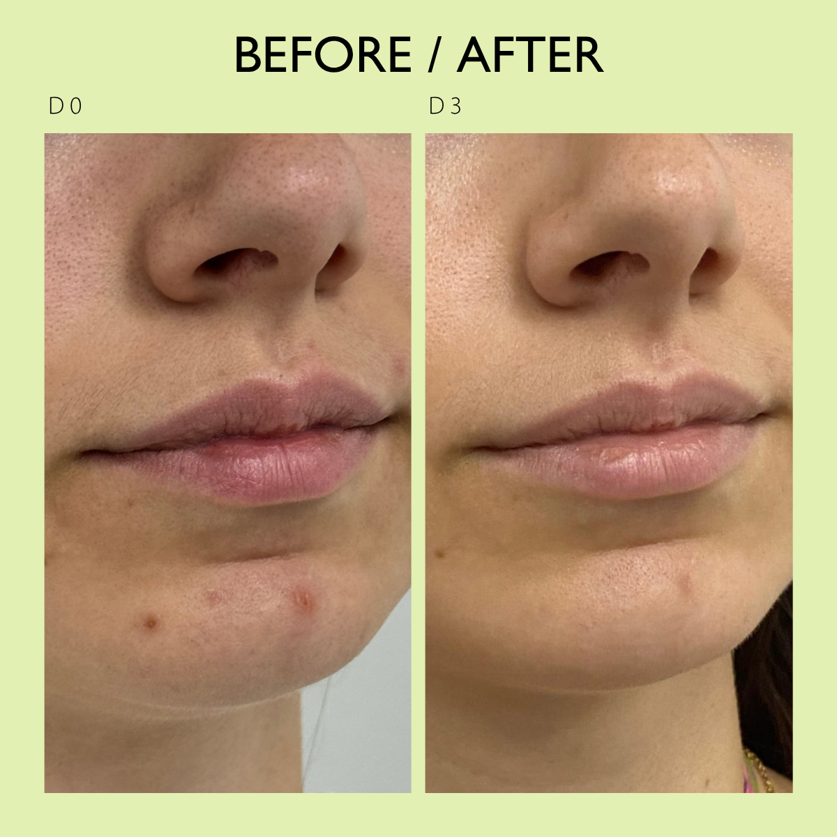 ACNIPURE before and after
